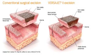 Dermis model for Versajet