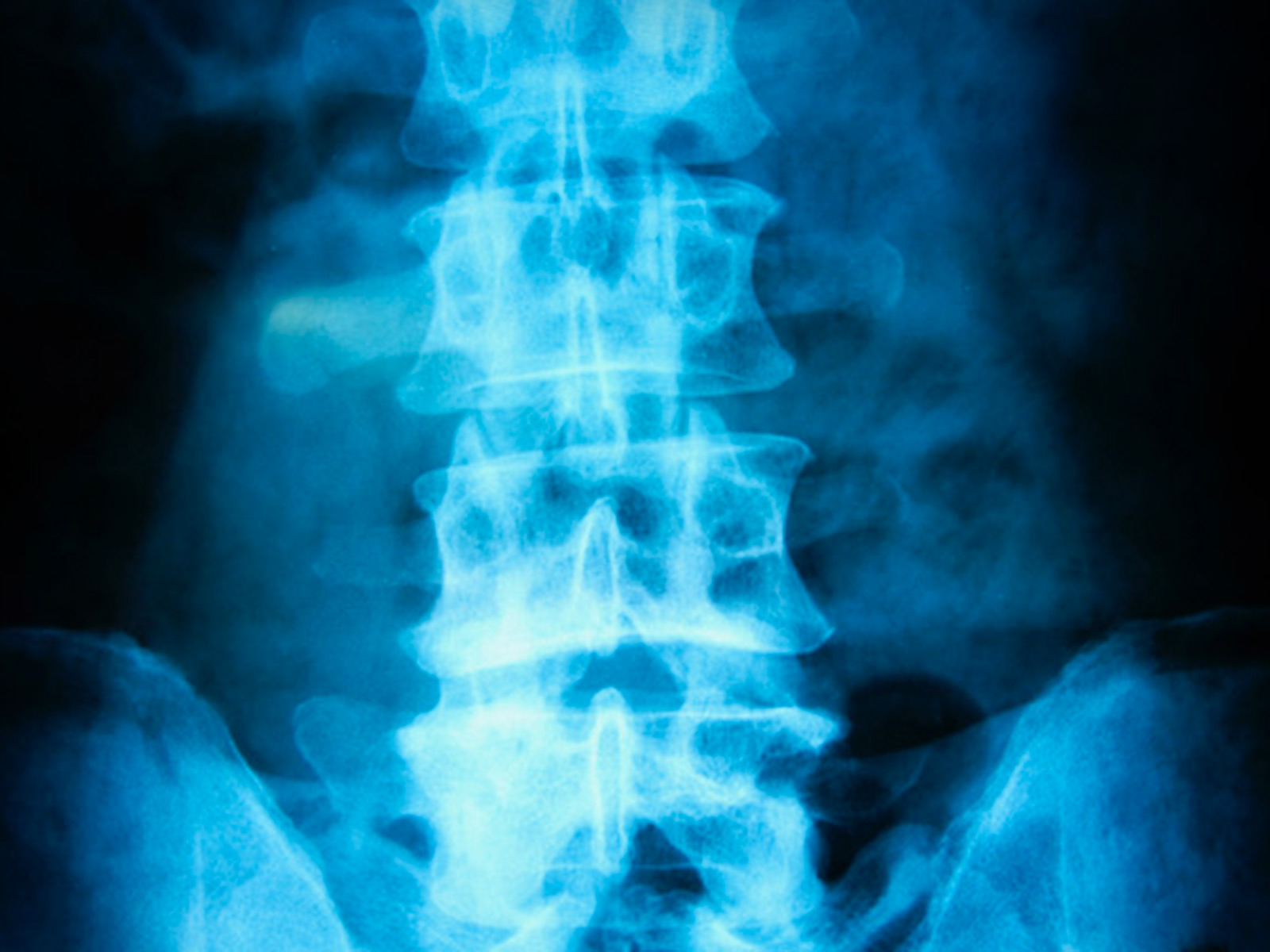 how-do-i-know-if-i-have-ruptured-a-disc-in-my-spine-health-journal