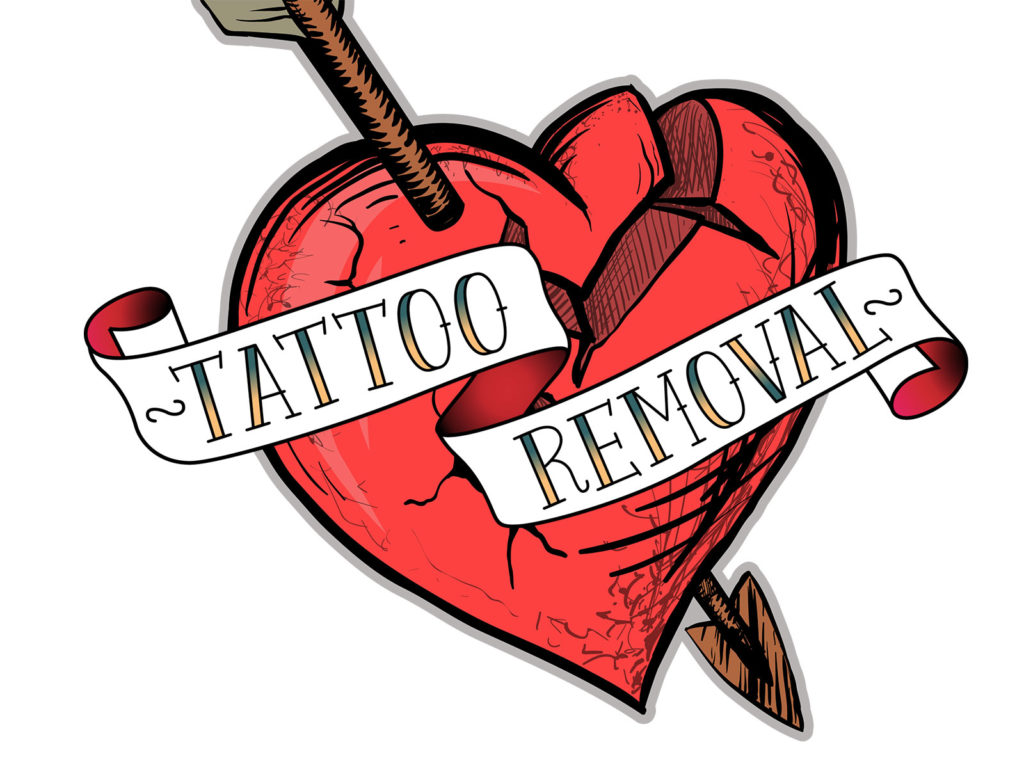 Tattoo Removal | MI Laser Clinic | Eastbourne, England, UK