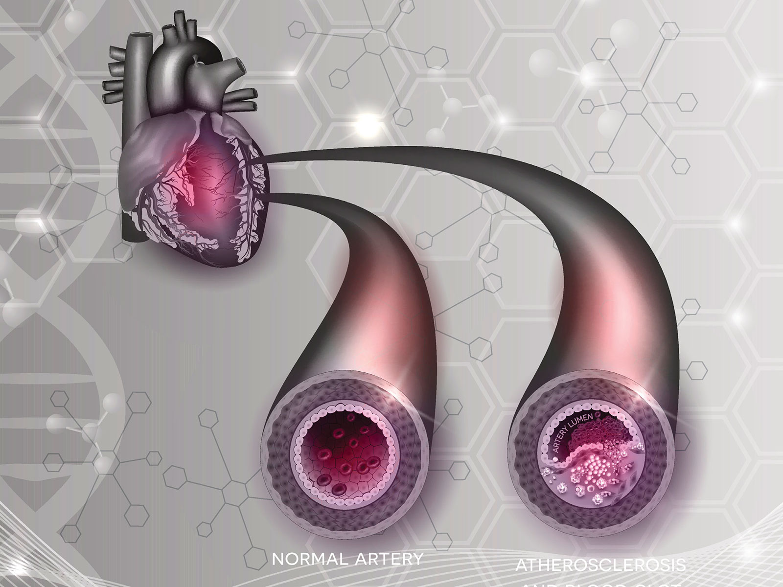 New AngioVac Procedure More Effective At Removing Blood Clots Health 