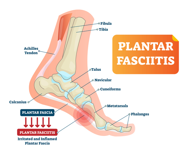 plantar fasciitis ankle pain