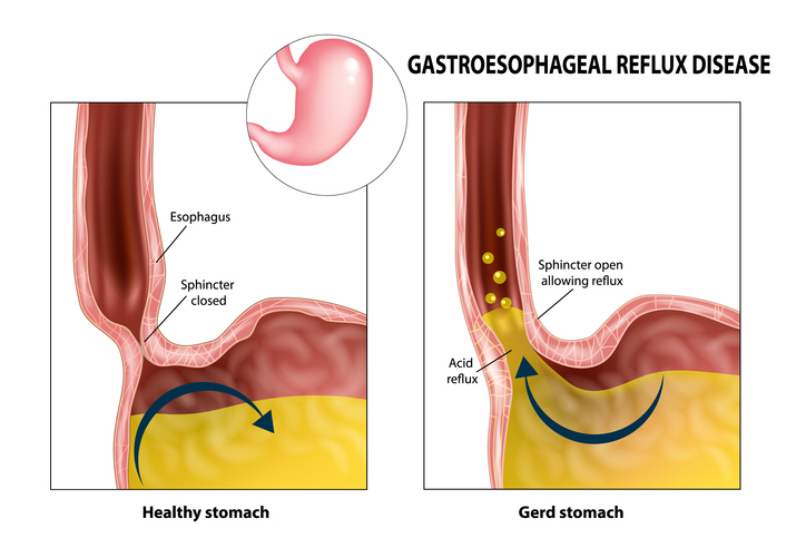 GERD Or Heart Attack MD Knowledge Health Journal